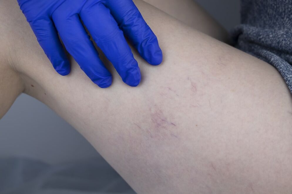 A sign of reticular varicose veins