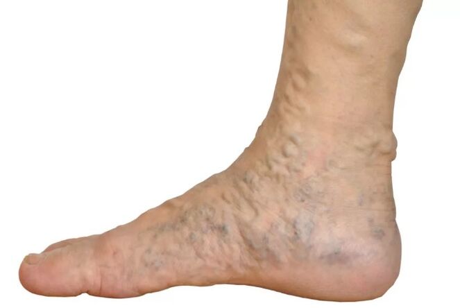 Veen's disease in the feet