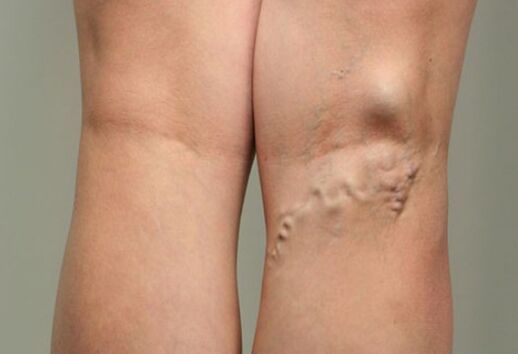 Vein