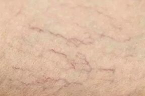 A vascular star