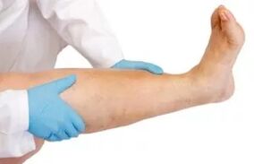Swollen the lower limbs