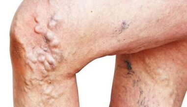 The main manifestation of varicose veins in the legs