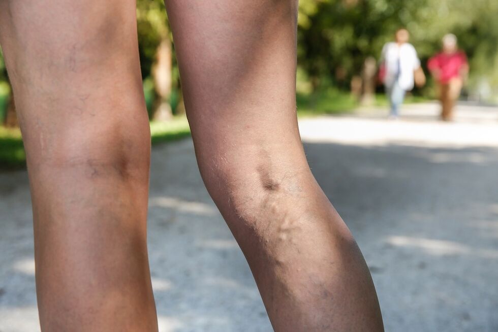 varicose veins in the legs