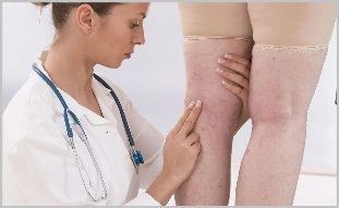 A woman sees a doctor with obvious signs of varicose veins