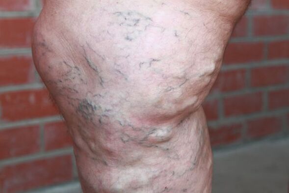 A sign of varicose veins