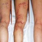 Varicose veins of the legs