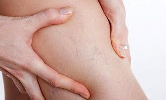 The reason for the development of varicose veins in the legs