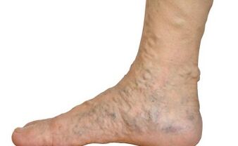 varicose veins