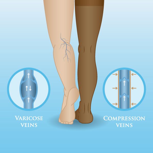 Effect of compression garments on varicose veins in the legs