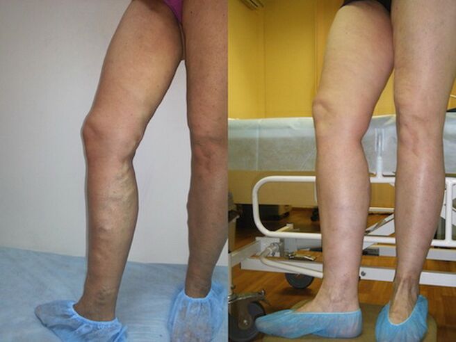 Legs before and after laser treatment on varicose veins