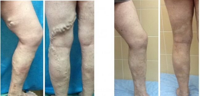 Legs before and after radio frequency remove veins with varicose veins