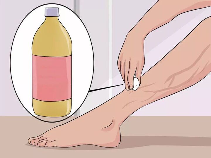 how to apply apple cider vinegar to the affected area