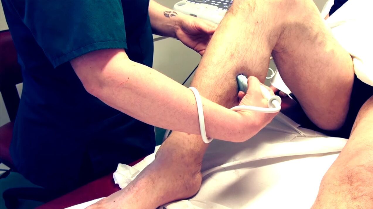 Duplex scanning of the veins in the lower leg for the diagnosis of varicose veins