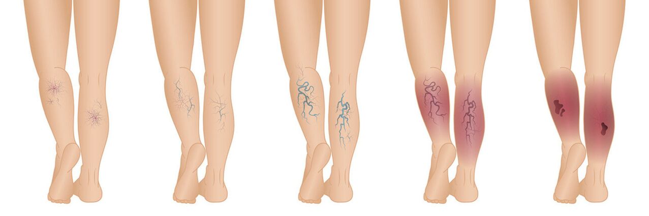 Stage of varicose veins in the lower part of the leg