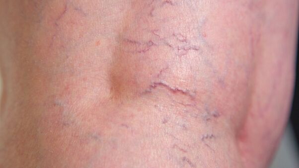 Signs of reticular varicose veins on the lower part of the legs - dilation of fine veins and vascular tissue