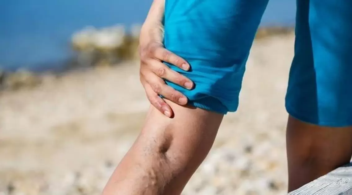 A bulging blue vein on the leg is a sign of varicose veins