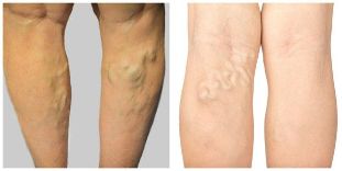 varicose veins are veins on the leg