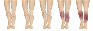 Varicose veins are the veins of the lower limbs in the
